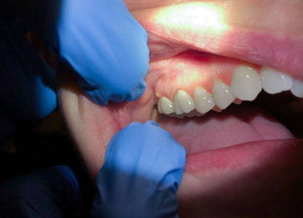 Best Knocked-Out Tooth (Avulsed Tooth) Treatment in Bloomfield, IN