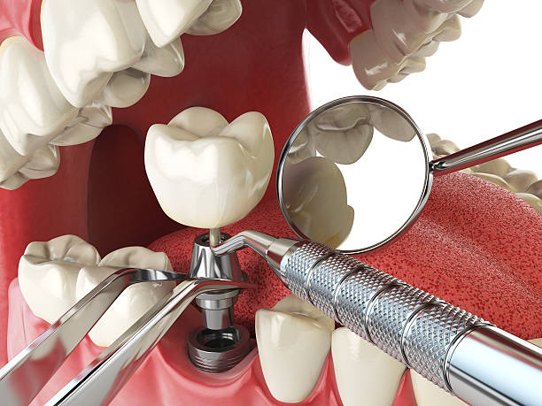 Best Emergency Denture Repair in Bloomfield, IN